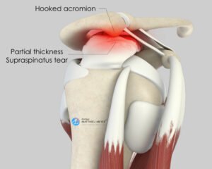 Arthroscopic Shoulder Acromioplasty Doctor Matthieu Meyer