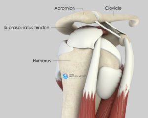 Arthroscopic Shoulder Acromioplasty - Doctor Matthieu Meyer