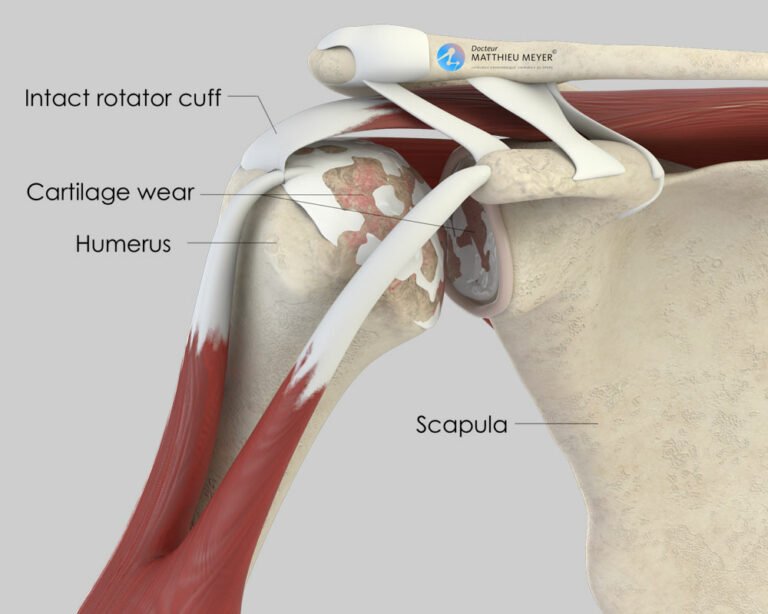 Total Shoulder Replacement - Doctor Matthieu Meyer