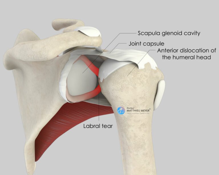 Arthroscopic Capsulolabral Repair (Bankart Procedure) - Doctor Matthieu ...