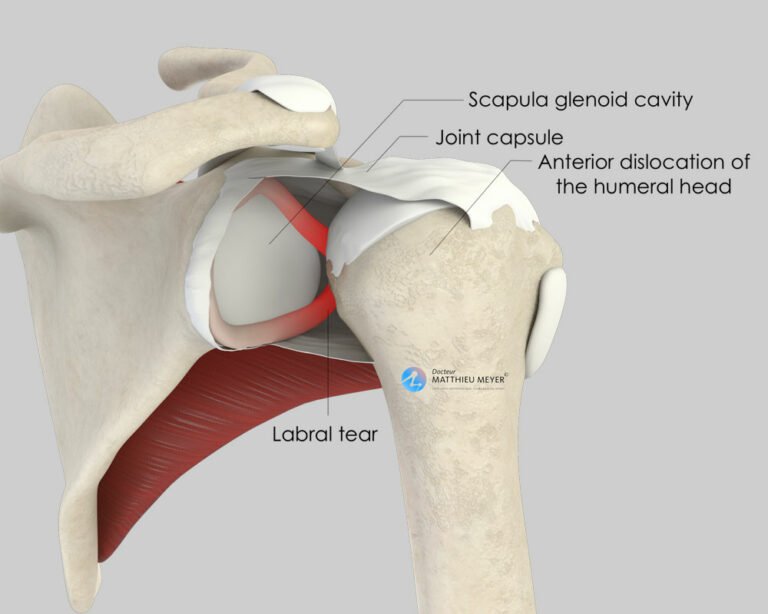 Coracoid Block (Latarjet Procedure) - Doctor Matthieu Meyer