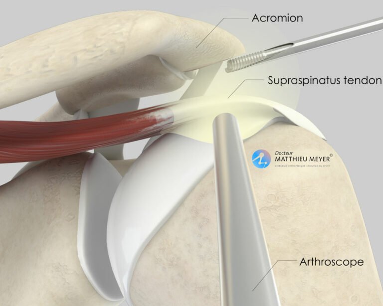 Arthroscopic Shoulder Acromioplasty - Doctor Matthieu Meyer