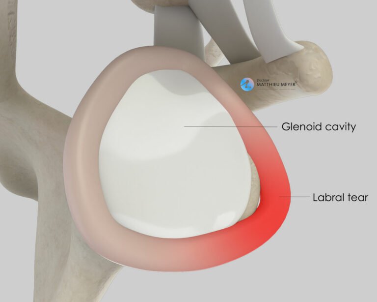 Arthroscopic Capsulolabral Repair (Bankart Procedure) - Doctor Matthieu ...