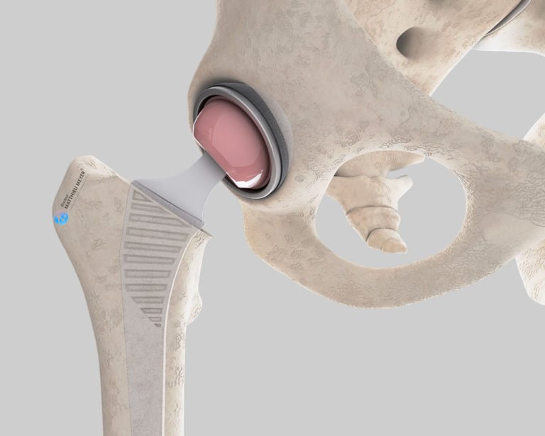 Minimally Invasive Anterior Approach Total Hip Replacement Doctor Matthieu Meyer