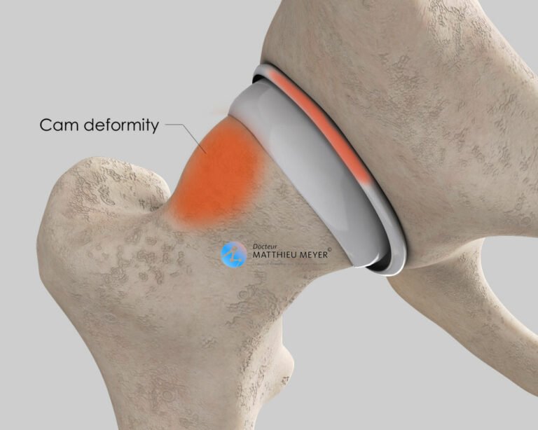 Anterior Hip Impingement Arthroscopy - Doctor Matthieu Meyer