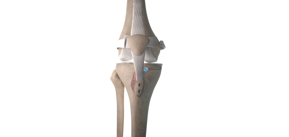 Anterior Tibial Tuberosity Transfer Patella Realignment - Doctor ...