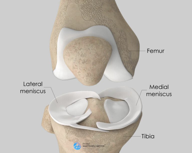 Arthroscopic Meniscal Surgery - Doctor Matthieu Meyer