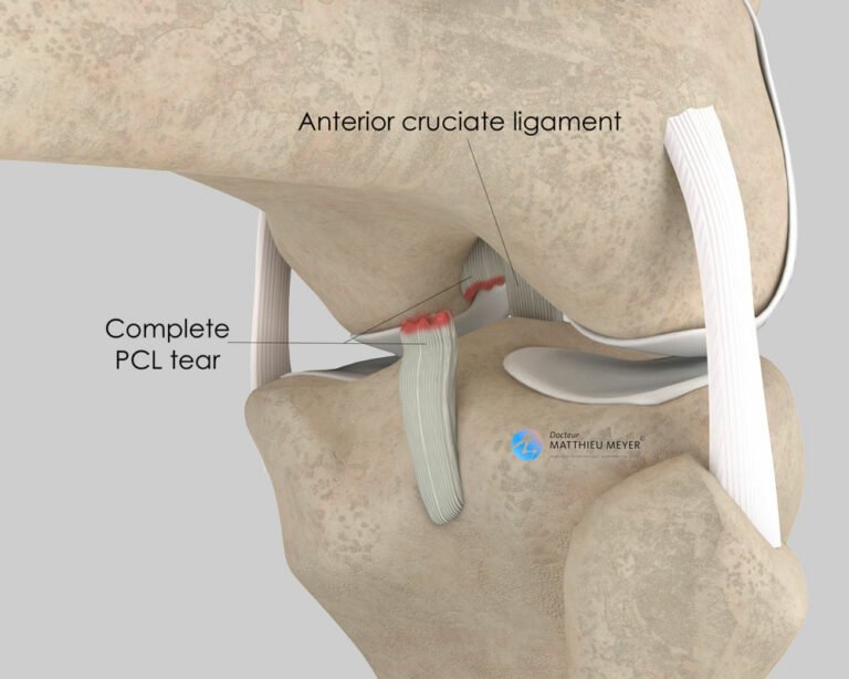 Posterior Cruciate Ligament Reconstruction - Doctor Matthieu Meyer