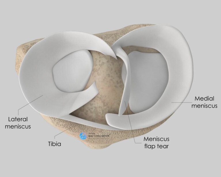 Arthroscopic Meniscal Surgery - Doctor Matthieu Meyer