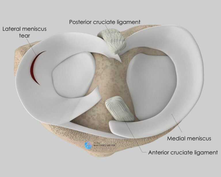 Arthroscopic Meniscal Surgery - Doctor Matthieu Meyer