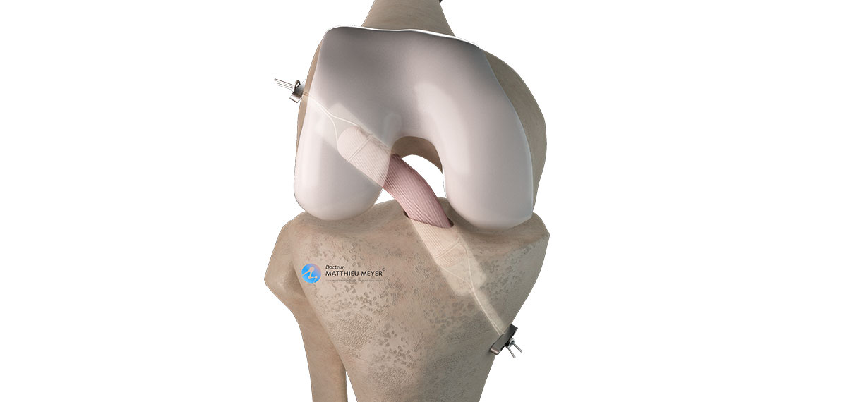 Final construct for patellar tendon primary repair using semitendinosus