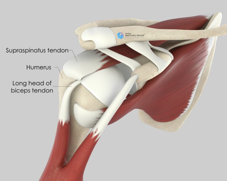 Arthroscopic Rotator Cuff Repair - Doctor Matthieu Meyer