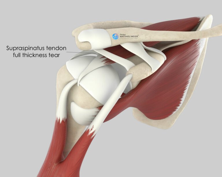 Arthroscopic Rotator Cuff Repair - Doctor Matthieu Meyer