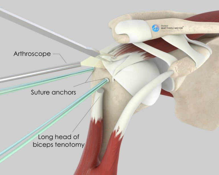 Arthroscopic Rotator Cuff Repair - Doctor Matthieu Meyer