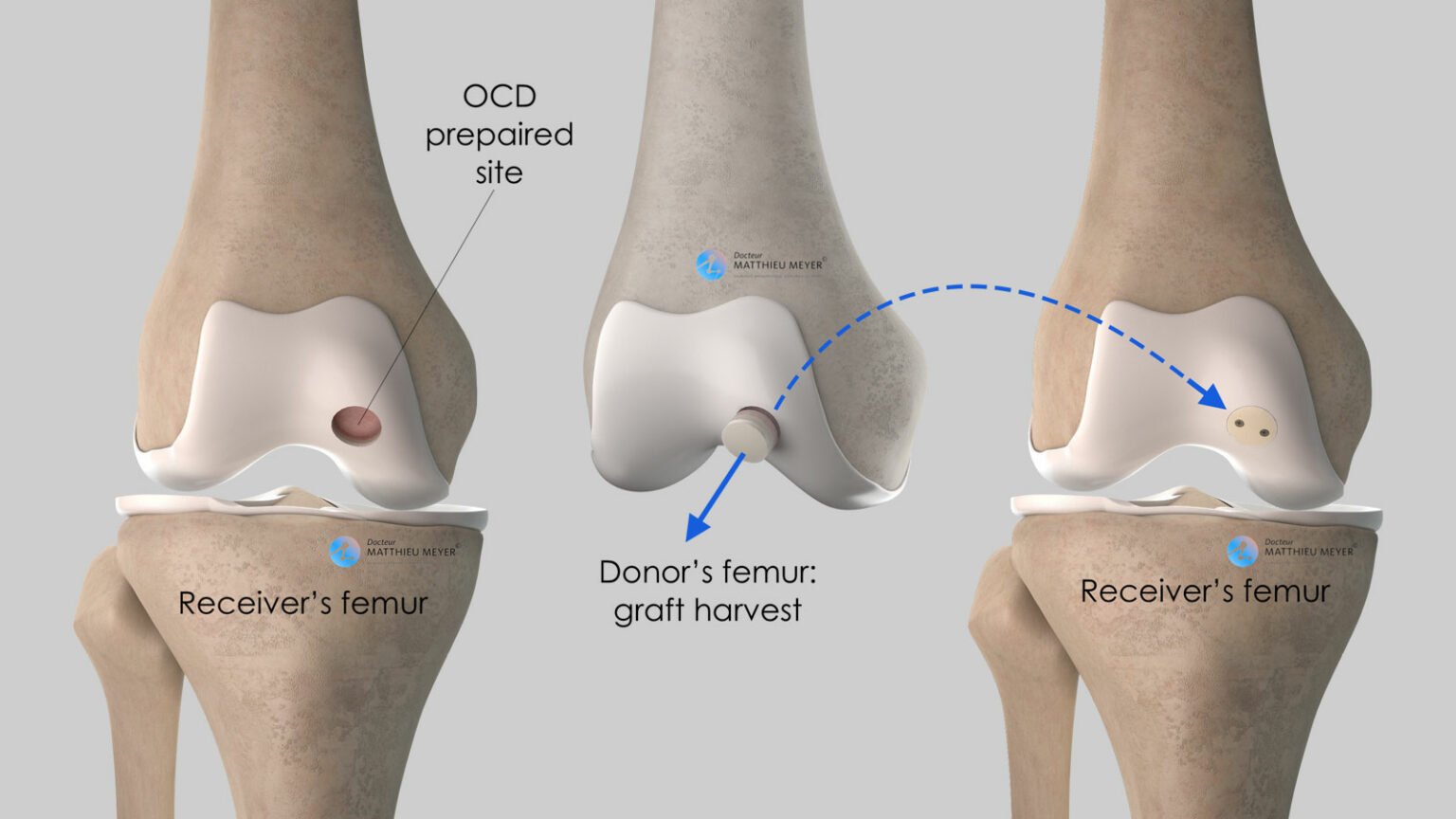 Drilling Fixation And Osteochrondral Grafts Doctor Matthieu Meyer 