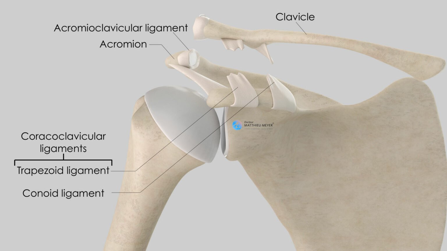 Acromioclavicular Dislocation - Doctor Matthieu Meyer