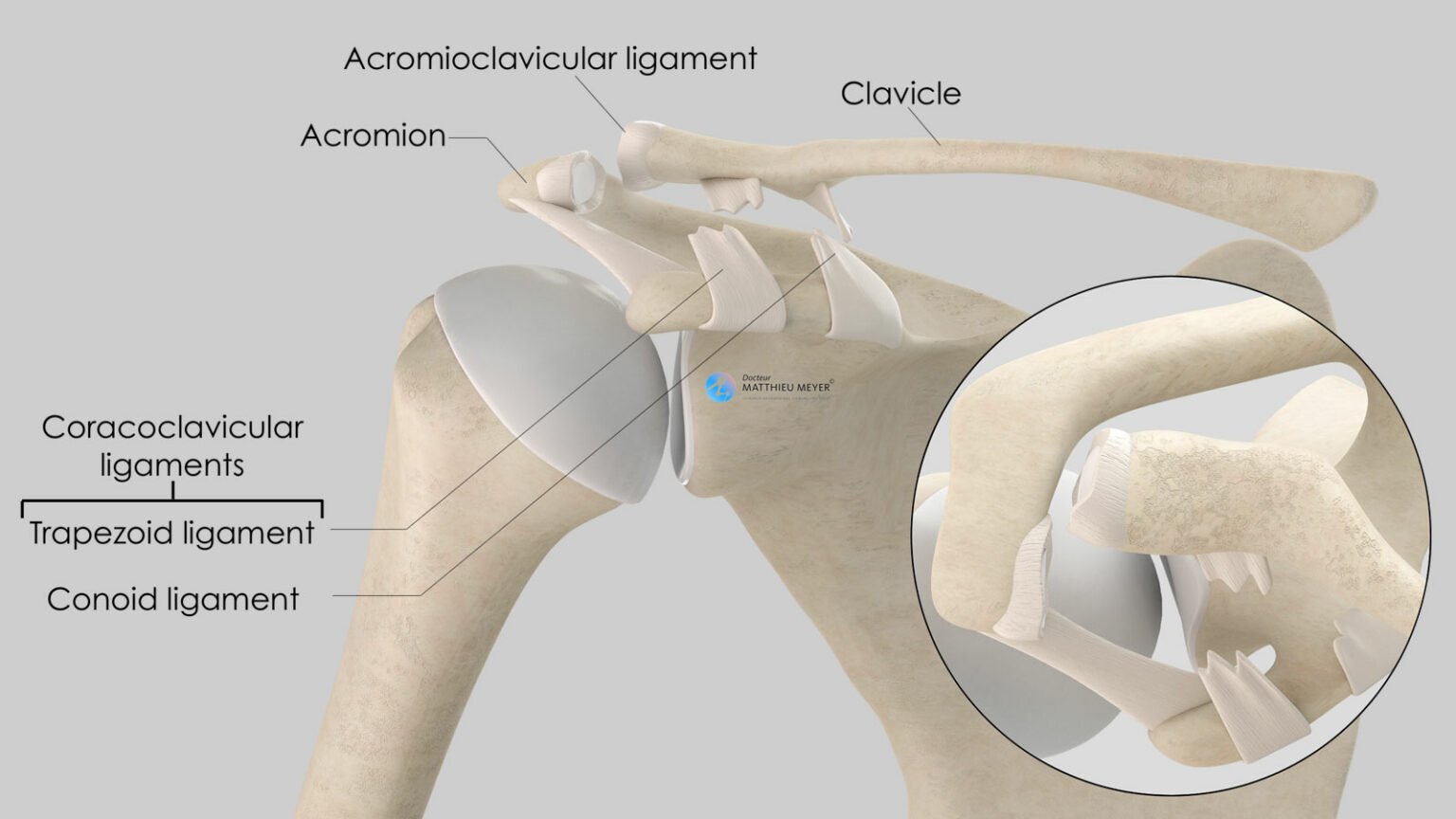 Acromioclavicular Dislocation Doctor Matthieu Meyer