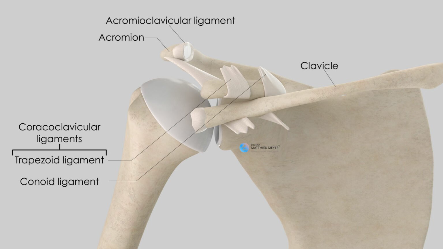 Acromioclavicular Dislocation - Doctor Matthieu Meyer