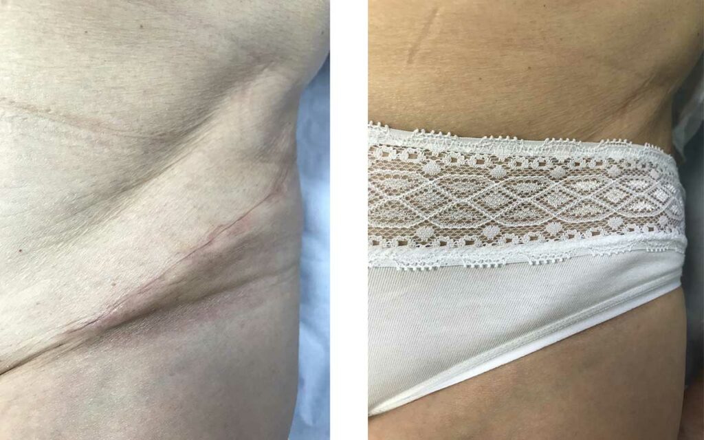 the-bikini-incision-a-new-type-of-minimally-invasive-anterior-approach